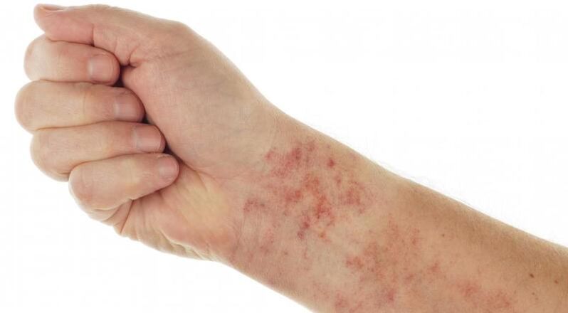 Hautausschläge bei Vorhandensein von Parasiten im Körper
